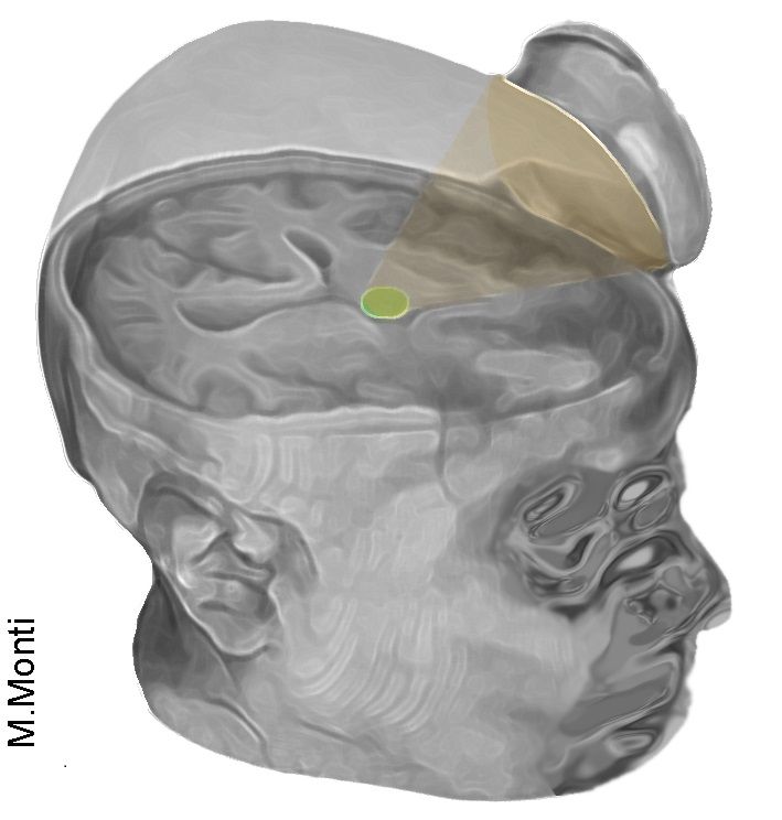 US researchers have "jump-started" the brain of a young man in a coma using low-intensity focused ultrasound pulsation targeted at his brain's thalamus. Photo / Martin Monti/UCLA